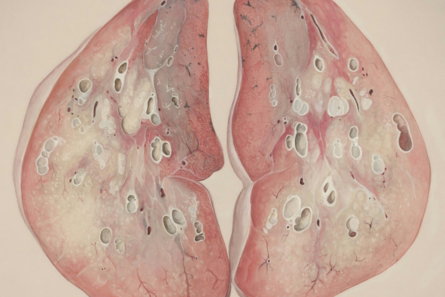 a medical illustration of the lungs